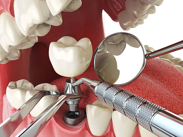 Best Emergency Wisdom Teeth Removal in Fernandina Beach, FL